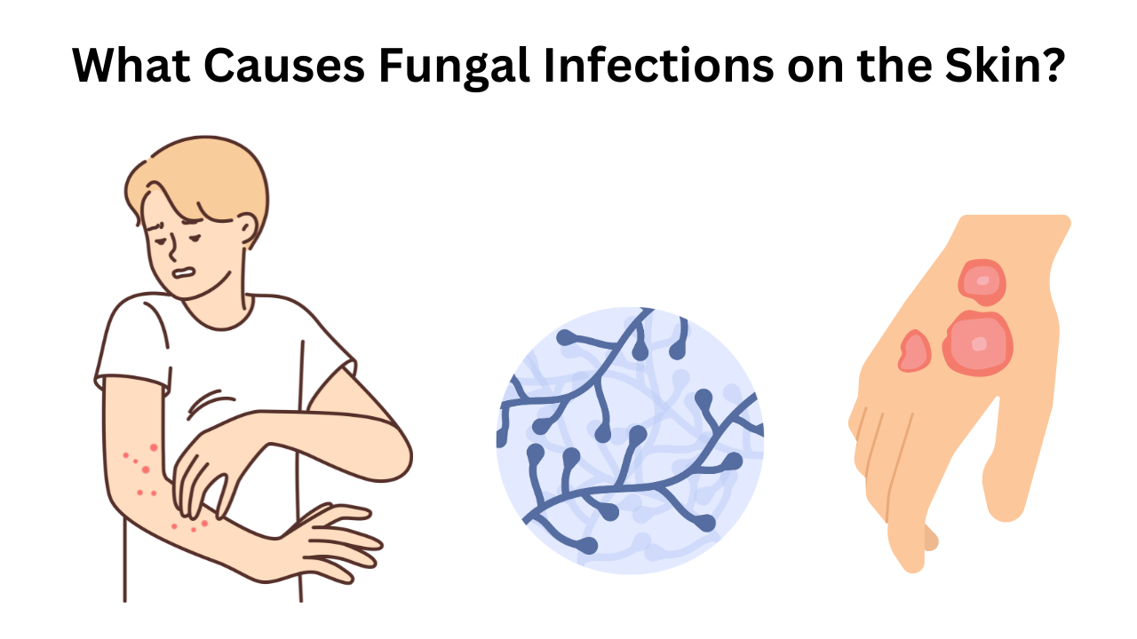 What Causes Fungal Infections on the Skin